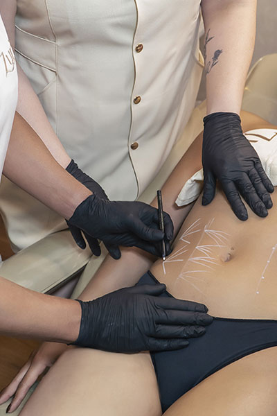 Bioestimuladores de Colágeno Corporais